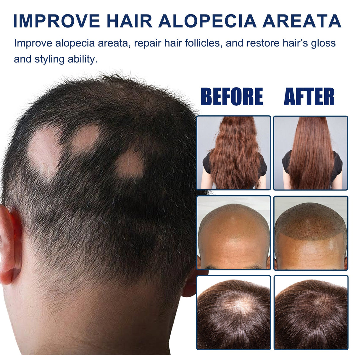 Alopecia Areata Care Set, Clean Scalp Supple Care Frizzy Hair Wash And Care Gift Set